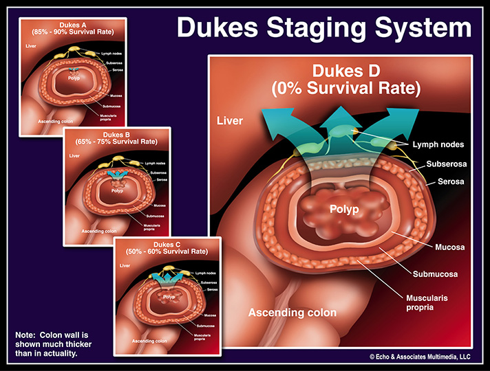 Dukes Staging System